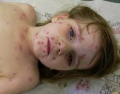 Alerte à la varicelle dans 12 régions de France !