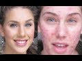 Vidéo maquillage - Enlever vos boutons d'acné facilement